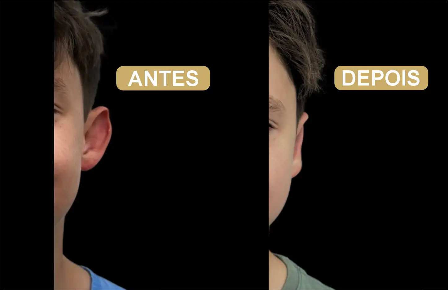Otoplastia em Blumenau - Otomedic