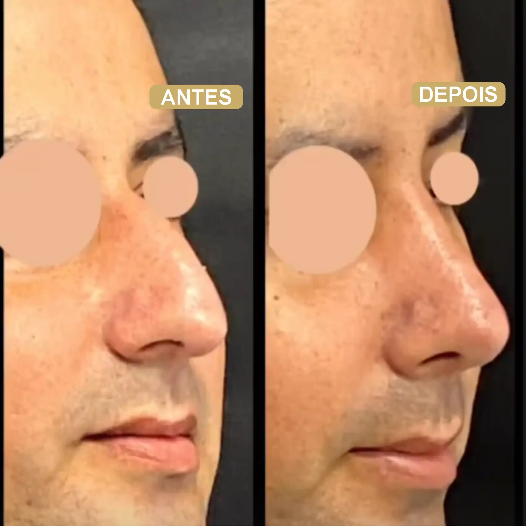 Resultado de Rinoplastia 01