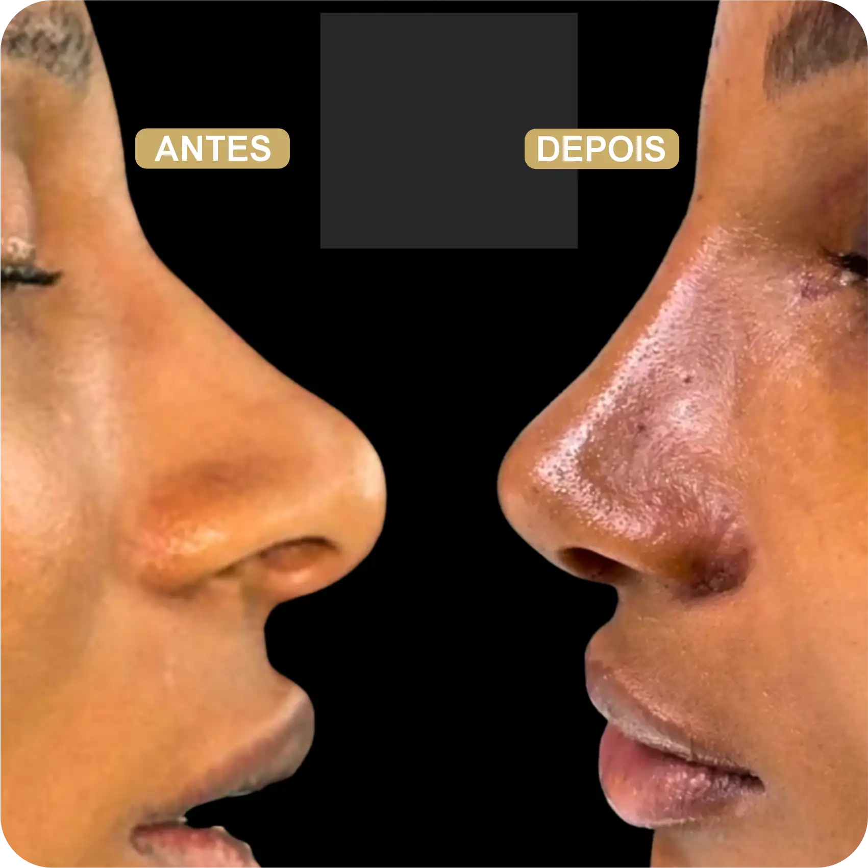 Resultado de Rinoplastia 02