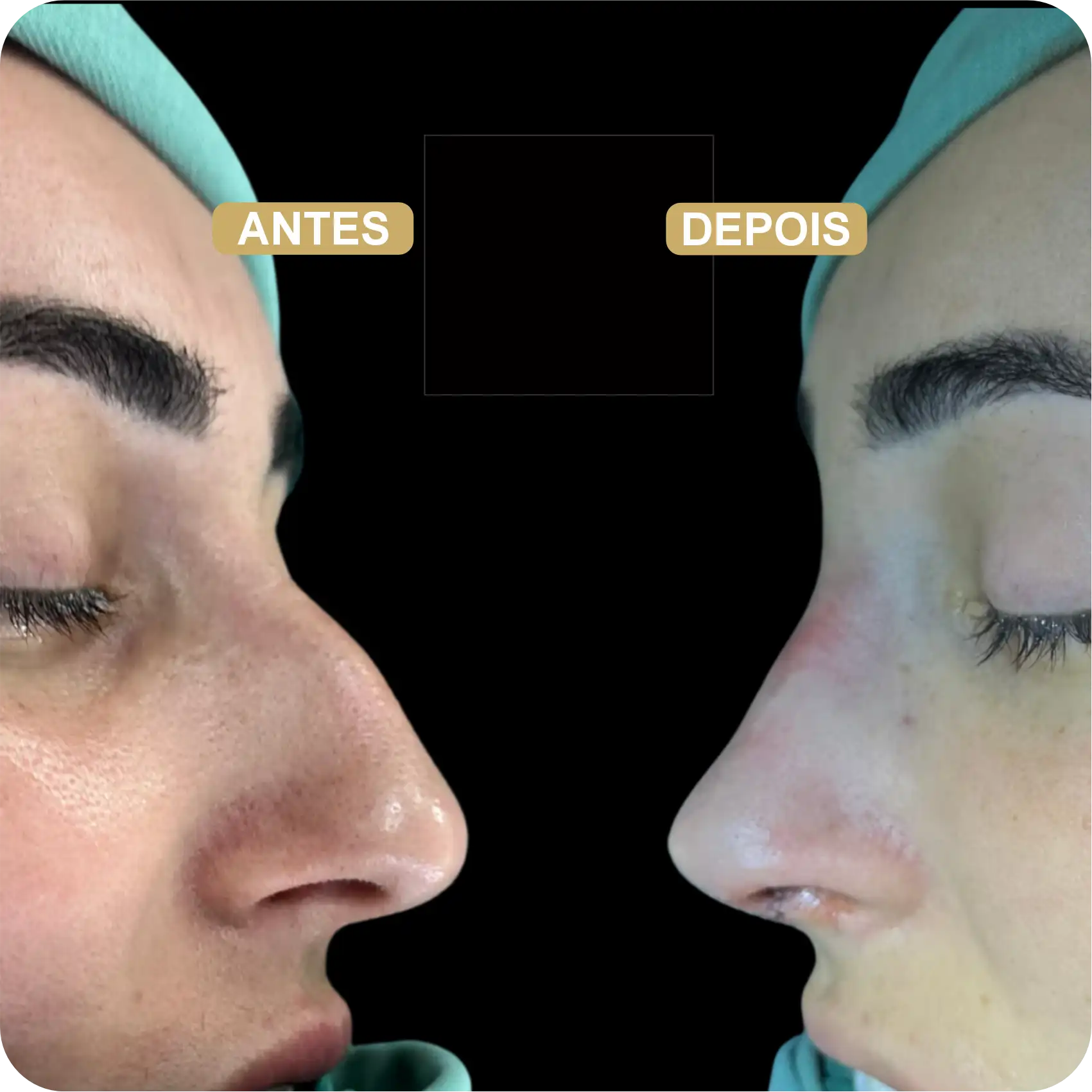 Resultado de Rinoplastia 03