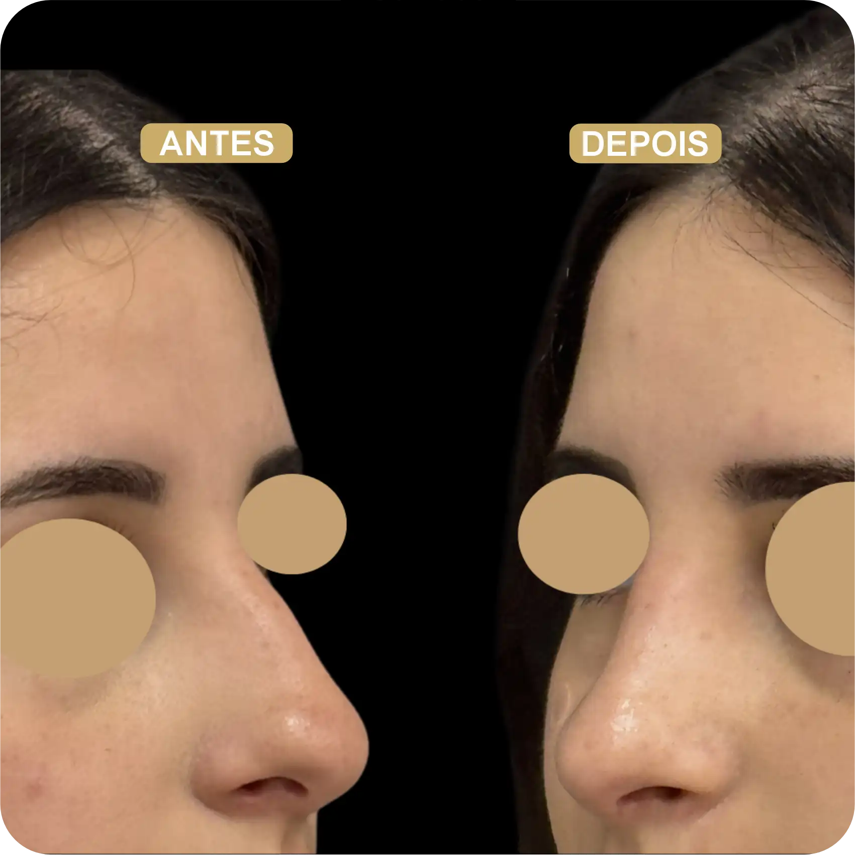 Resultado de Rinoplastia 04