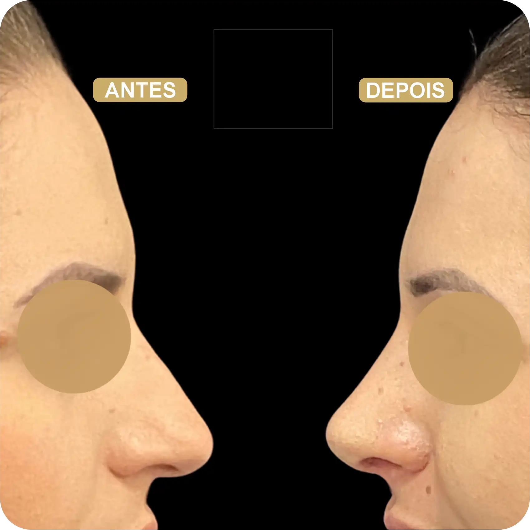 Resultado de Rinoplastia 05