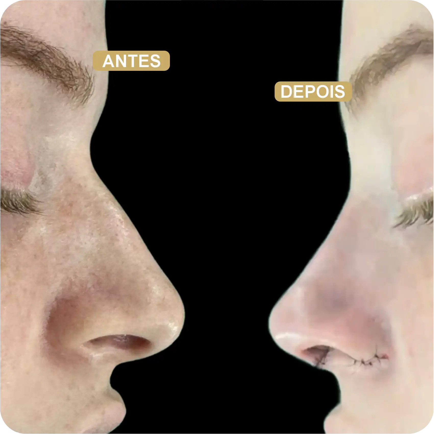 Resultado de Rinoplastia 06