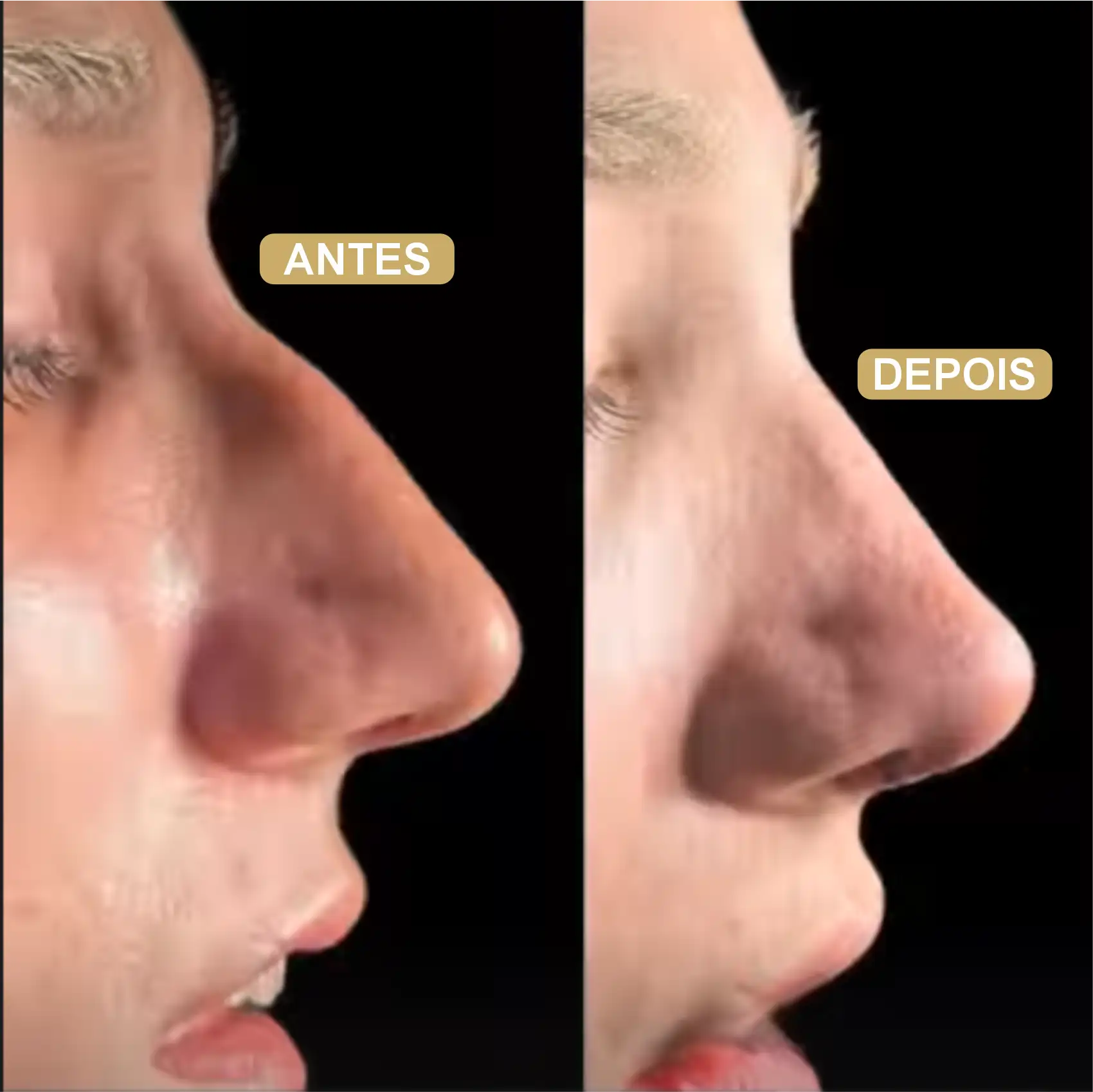 Resultado de Rinoplastia 07