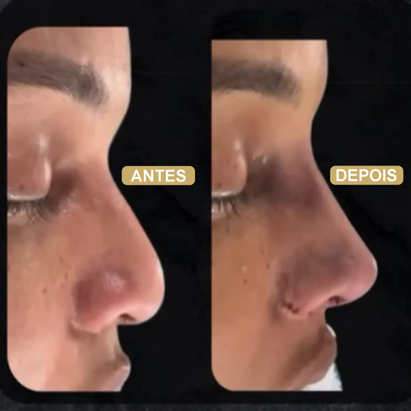 Resultado de Rinoplastia 08