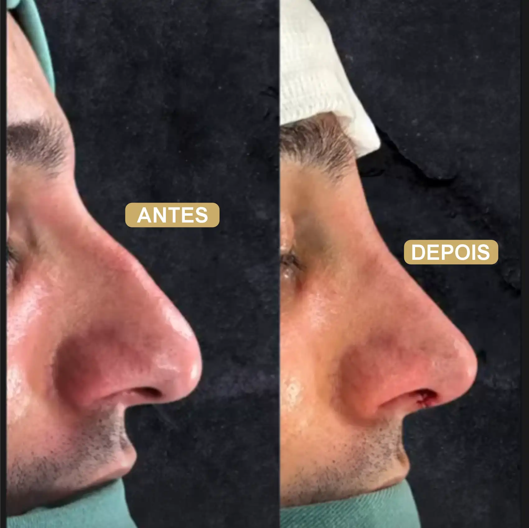 Resultado de Rinoplastia 09
