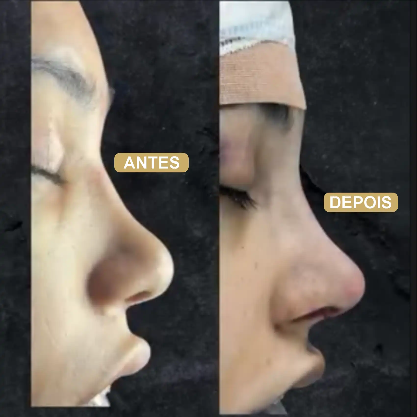 Resultado de Rinoplastia 10