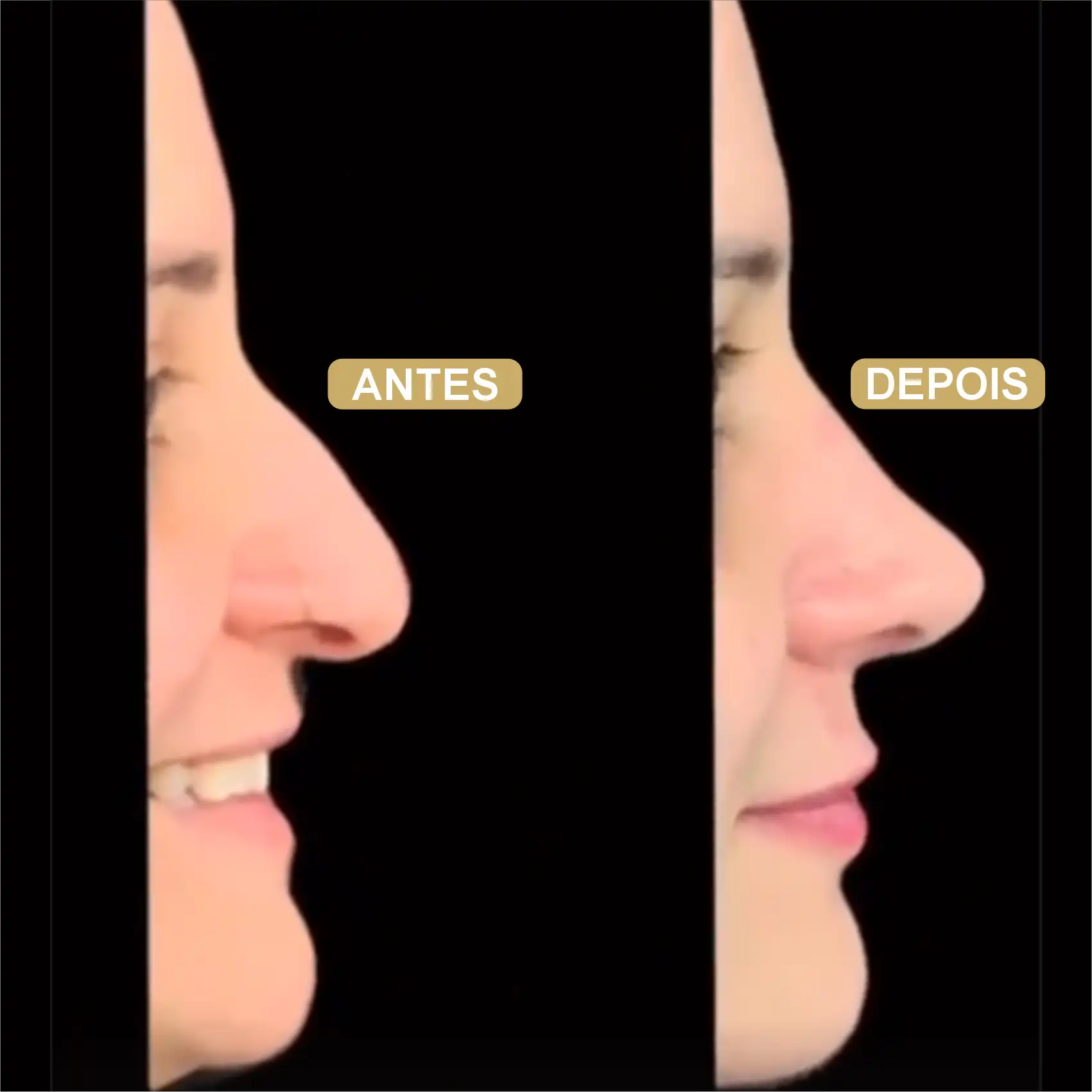 Resultado de Rinoplastia 11