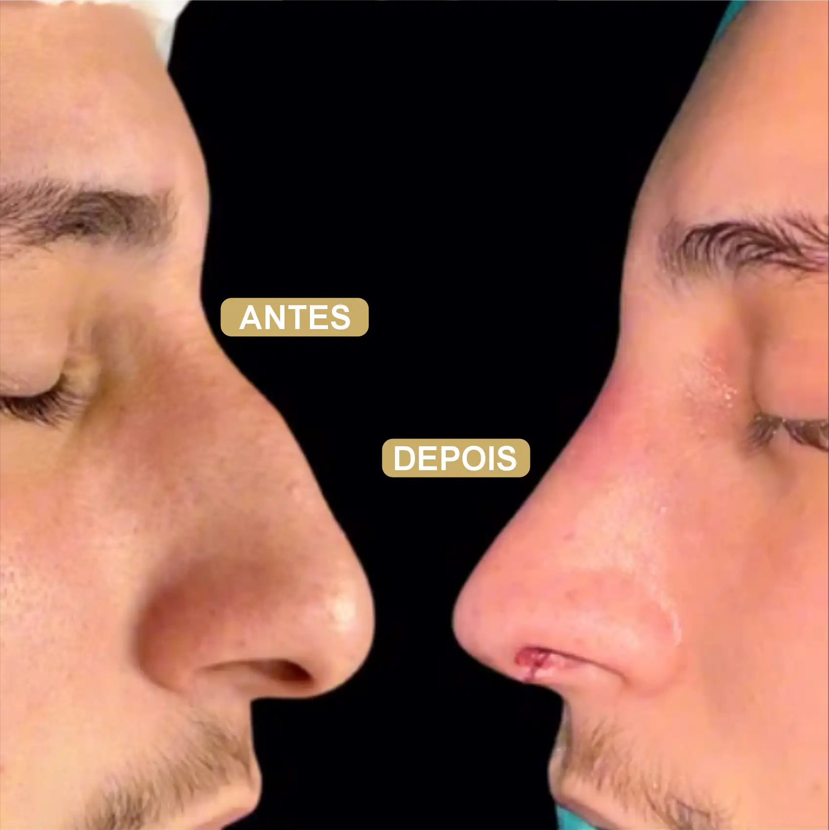 Resultado de Rinoplastia 12